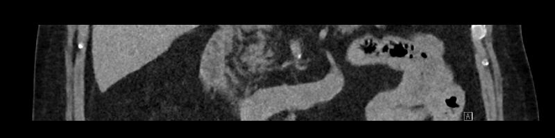 File:Buried bumper syndrome - gastrostomy tube (Radiopaedia 63843-72575 Coronal Inject 47).jpg