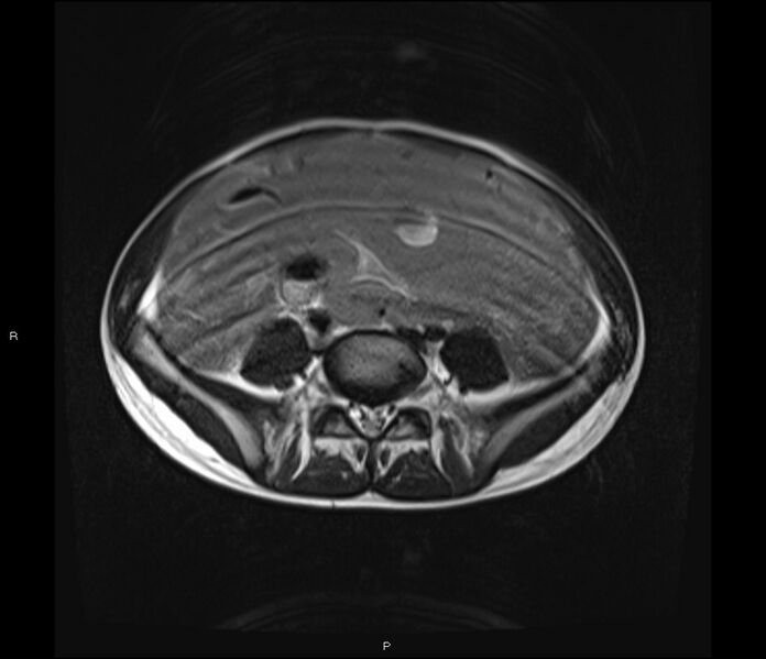 File:Burkitt lymphoma (bowel) (Radiopaedia 68839-78557 Axial T2 43).jpg