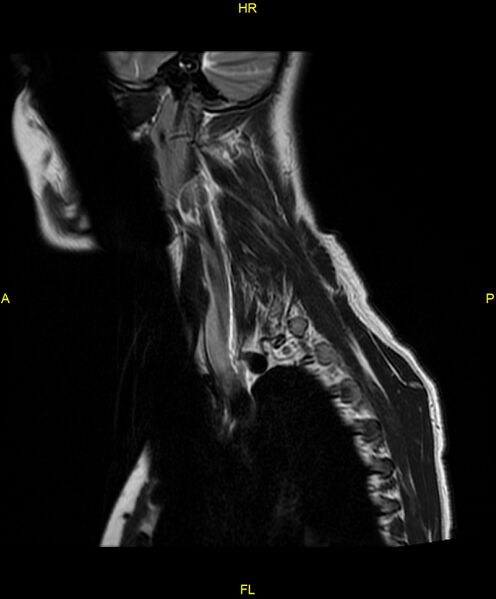 File:C5 nerve sheath tumor (Radiopaedia 85777-101596 Sagittal T2 4).jpg