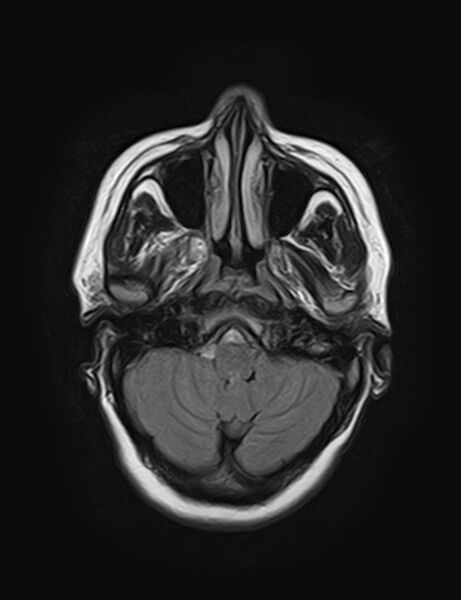 File:Calcified cerebral hydatid cyst (Radiopaedia 65603-74699 Axial FLAIR 4).jpg