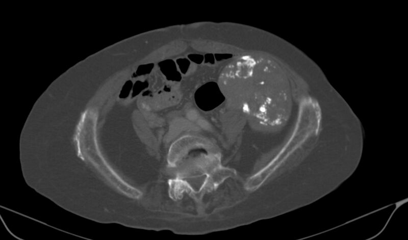 File:Calcified fibroids (Radiopaedia 20306-20228 Axial bone window 8).jpg