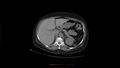 Calcified spleen (Radiopaedia 60952-68768 Axial non-contrast 7).jpg