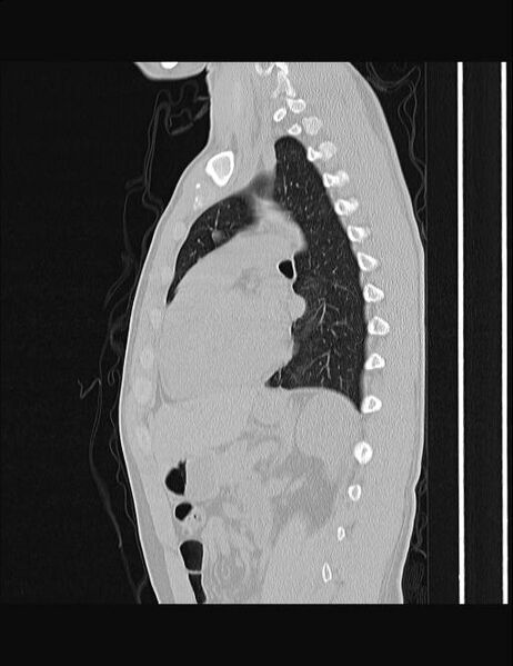 File:Calcifying pulmonary metastases (Radiopaedia 33359-34396 Sagittal lung window 28).jpg