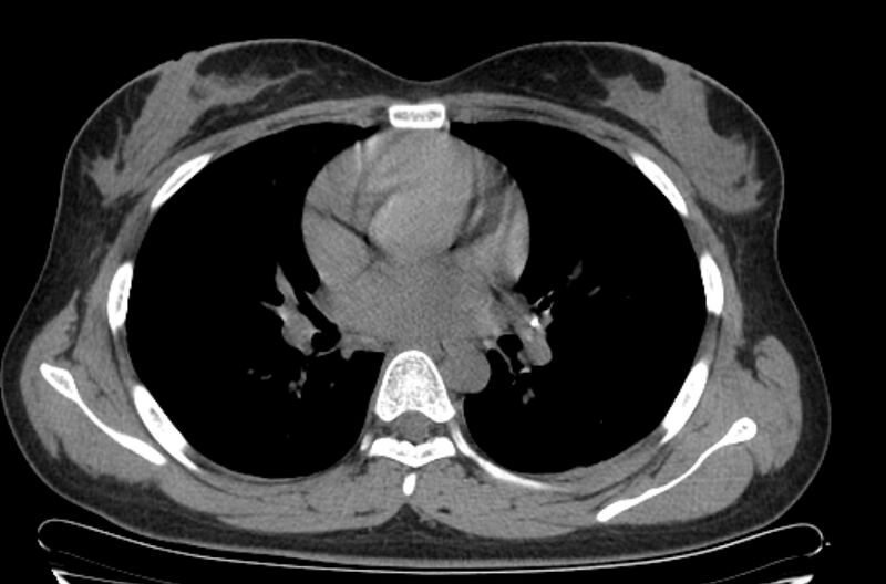 File:Cannonball metastases - uterine choriocarcinoma (Radiopaedia 70137-80173 Axial non-contrast 56).jpg
