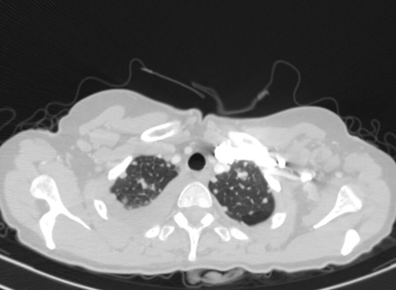 File:Cannonball metastases from breast cancer (Radiopaedia 91024-108569 Axial lung window 8).jpg