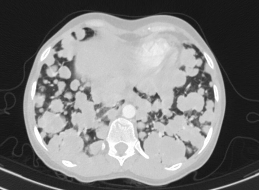 Cannonball metastases from breast cancer (Radiopaedia 91024-108569 Axial lung window 83).jpg