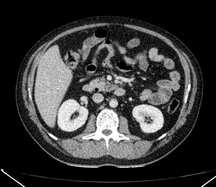 File:Carcinoid tumor with hepatic metastases (Radiopaedia 22651-22670 C 45).jpg