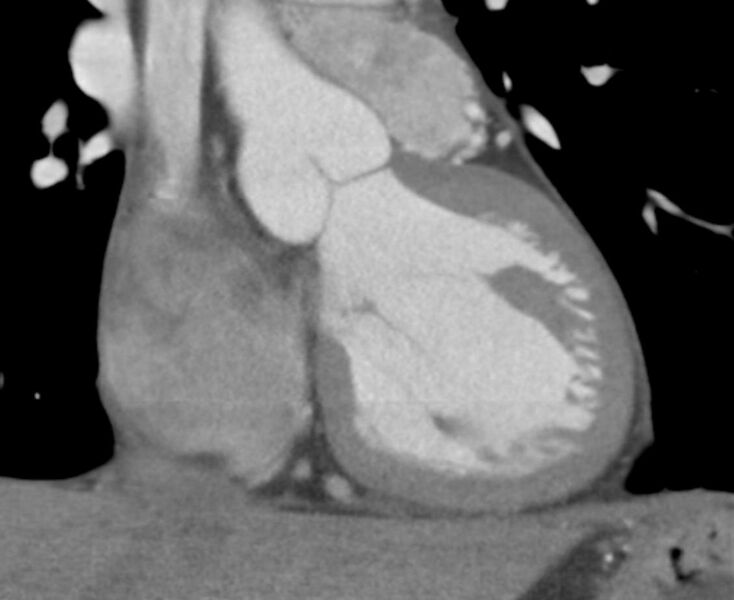 File:Cardiac hemangioma (Radiopaedia 16971-16679 B 6).JPG