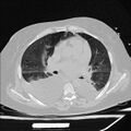 Cardiogenic pulmonary edema (Radiopaedia 29213-29609 Axial lung window 45).jpg