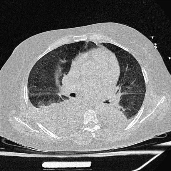 File:Cardiogenic pulmonary edema (Radiopaedia 29213-29609 Axial lung window 45).jpg