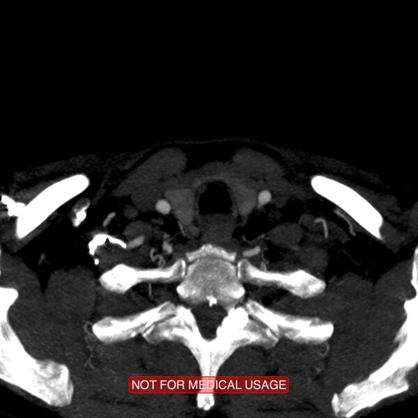 File:Carotid artery stenosis (Radiopaedia 28786-29086 C 24).jpg