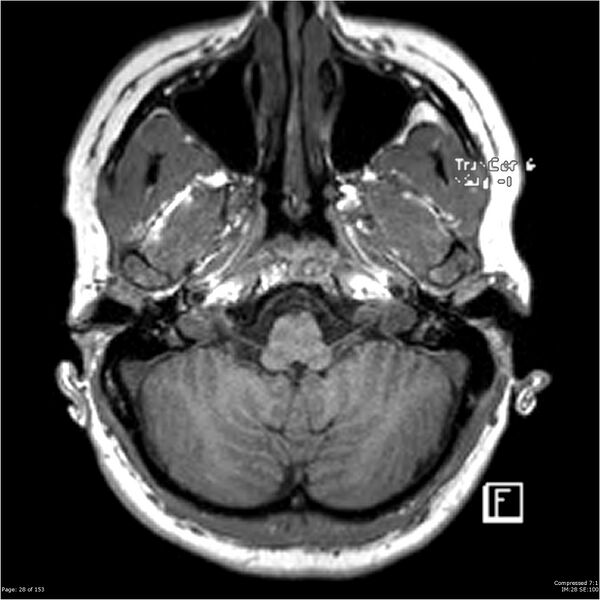 File:Cavernous malformation (cavernous angioma or cavernoma) (Radiopaedia 36675-38237 Axial T1 17).jpg