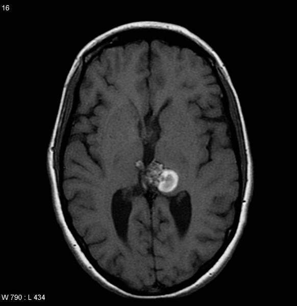 File:Cavernous malformation of the midbrain (Radiopaedia 7791-8615 Axial T1 5).jpg