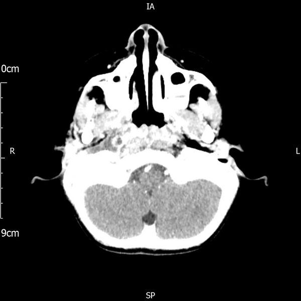 File:Cavernous sinus thrombosis (Radiopaedia 79414-92510 Axial Brain 53).jpg