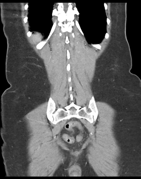 File:Cecum hernia through the foramen of Winslow (Radiopaedia 46634-51112 B 40).png
