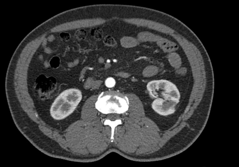 File:Celiac artery dissection (Radiopaedia 52194-58080 A 50).jpg