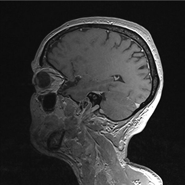 File:Central base of skull meningioma (Radiopaedia 53531-59549 Sagittal T1 C+ 57).jpg