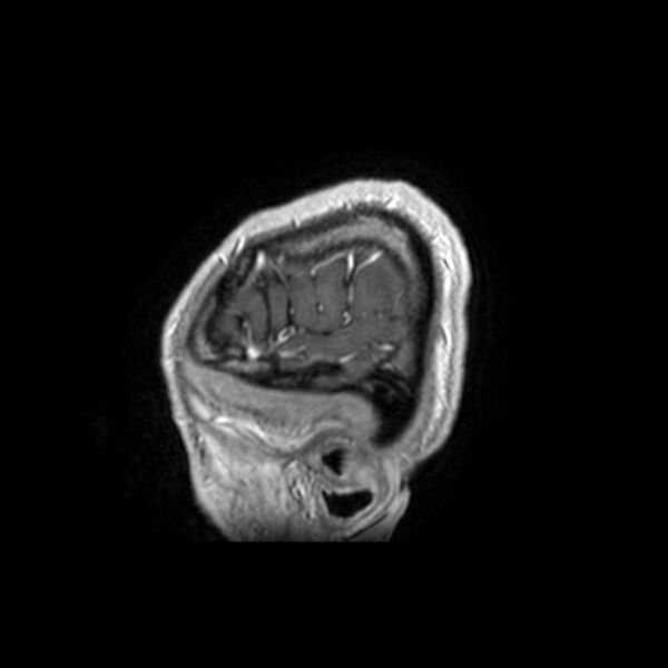 File:Central neurocytoma (Radiopaedia 67618-77021 Sagittal T1 C+ 27).jpg