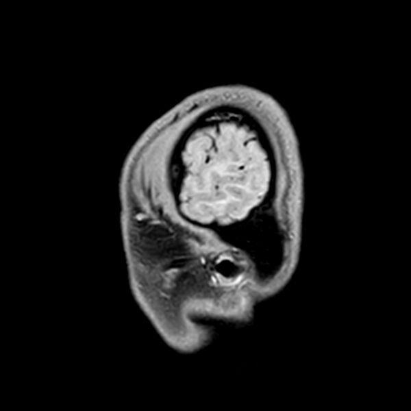 File:Central neurocytoma (Radiopaedia 79320-92380 Sagittal T1 240).jpg