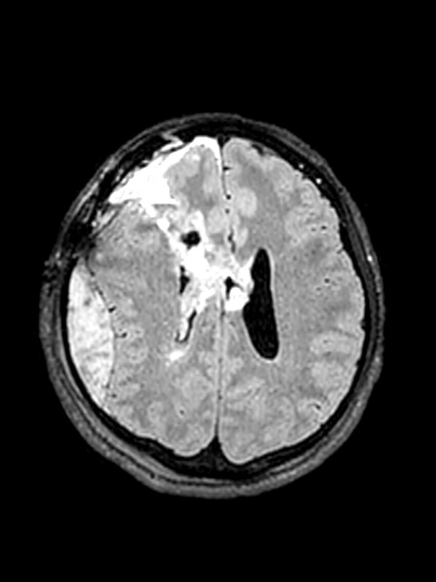 Central neurocytoma (Radiopaedia 79320-92381 Axial FLAIR 65).jpg
