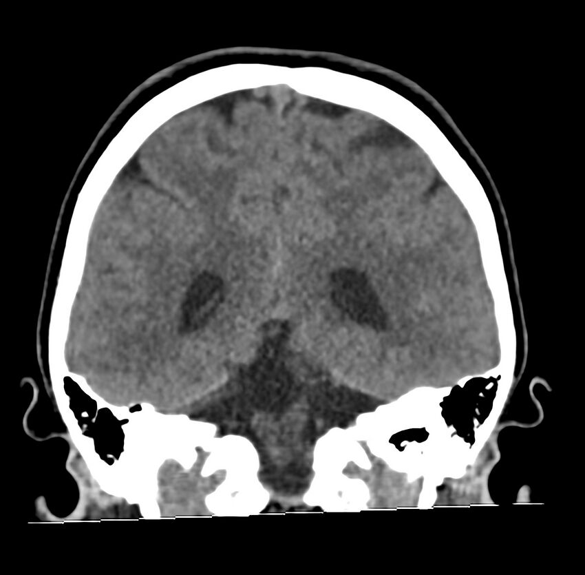 Cerebellar agenesis (Radiopaedia 30203-30817 Coronal non-contrast 29).jpg