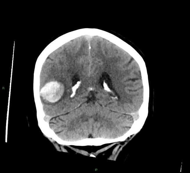 File:Cerebral amyloid angiopathy-associated lobar intracerebral hemorrhage (Radiopaedia 58378-65516 Coronal non-contrast 22).jpg