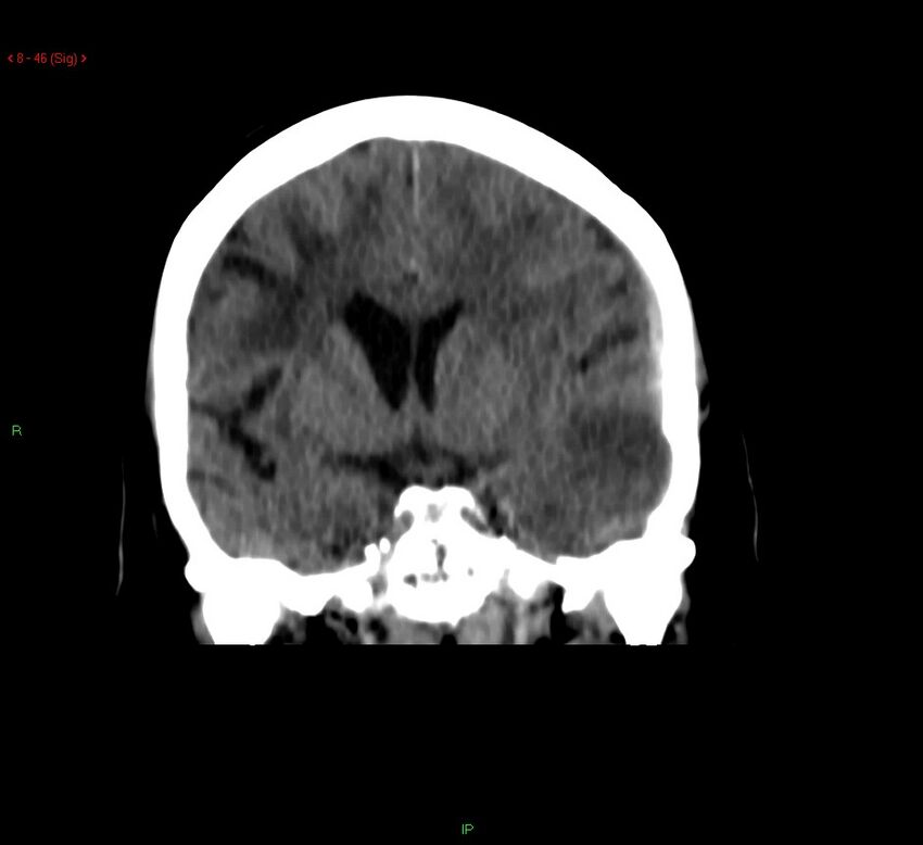 Cerebral amyloid angiopathy-associated lobar intracerebral hemorrhage (Radiopaedia 58378-65518 Coronal non-contrast 46).jpg