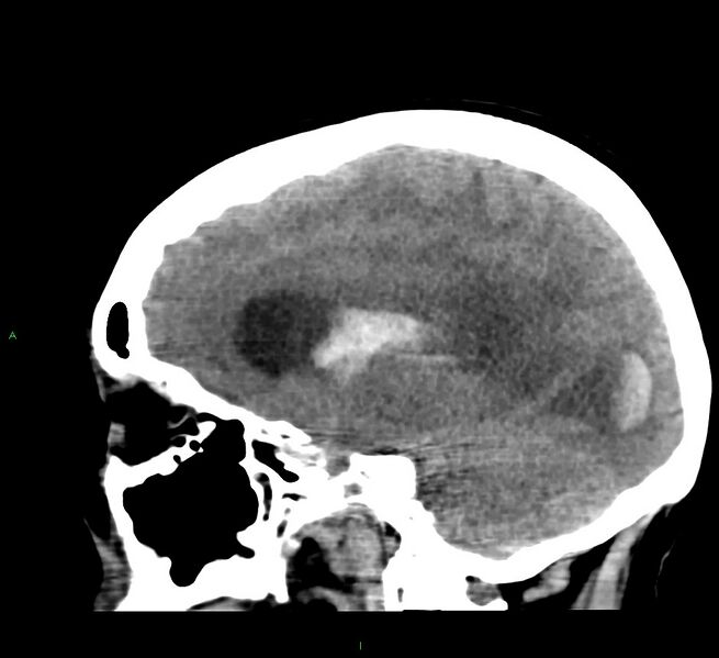 File:Cerebral amyloid angiopathy-associated lobar intracerebral hemorrhage (Radiopaedia 58379-65519 C 33).jpg