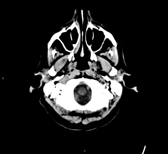 File:Cerebral amyloid angiopathy-associated lobar intracerebral hemorrhage (Radiopaedia 58529-65681 Axial non-contrast 48).jpg