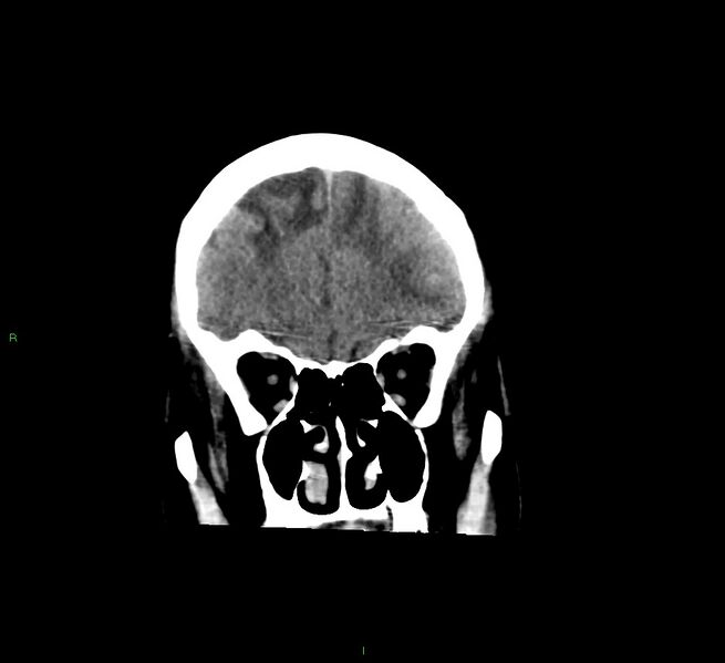 File:Cerebral amyloid angiopathy-associated lobar intracerebral hemorrhage (Radiopaedia 58529-65681 Coronal non-contrast 51).jpg