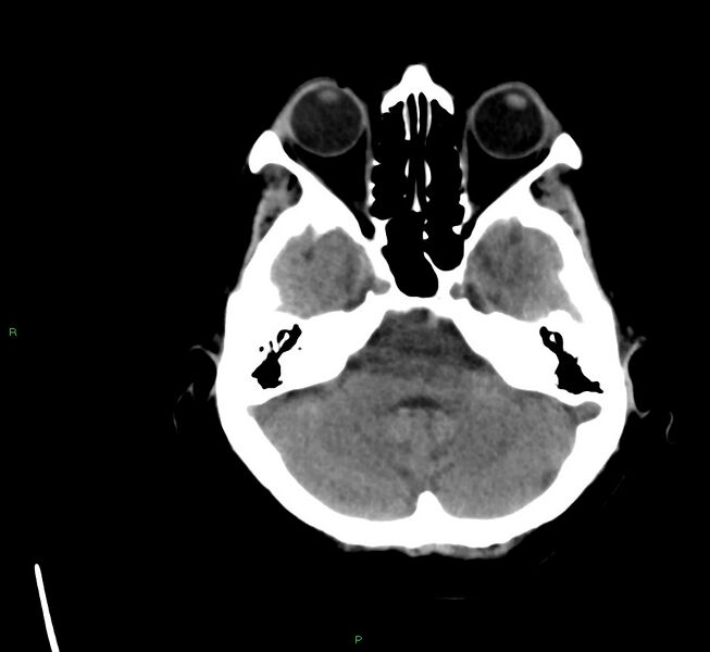 File:Cerebral amyloid angiopathy-associated lobar intracerebral hemorrhage (Radiopaedia 58561-65724 Axial non-contrast 36).jpg