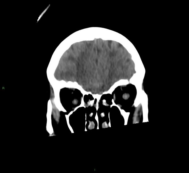 File:Cerebral amyloid angiopathy-associated lobar intracerebral hemorrhage (Radiopaedia 58566-65730 Coronal non-contrast 55).jpg