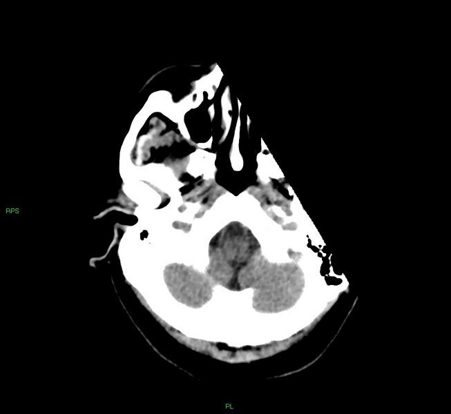 File:Cerebral amyloid angiopathy-associated lobar intracerebral hemorrhage (Radiopaedia 58569-65734 Axial non-contrast 50).jpg