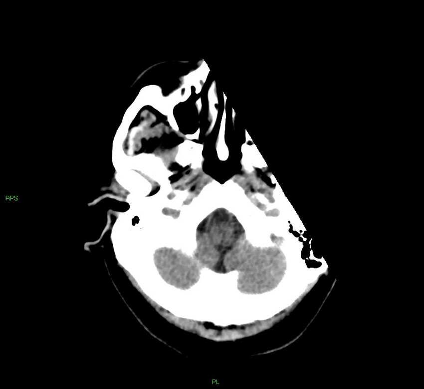 Cerebral amyloid angiopathy-associated lobar intracerebral hemorrhage (Radiopaedia 58569-65734 Axial non-contrast 50).jpg
