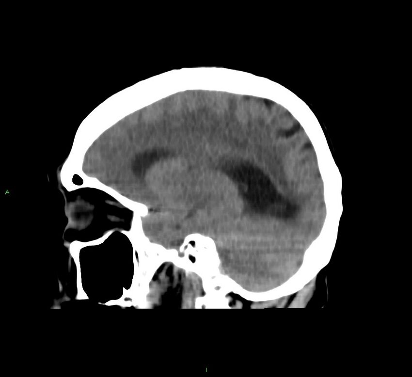 Cerebral amyloid angiopathy-associated lobar intracerebral hemorrhage (Radiopaedia 58751-65972 C 36).jpg