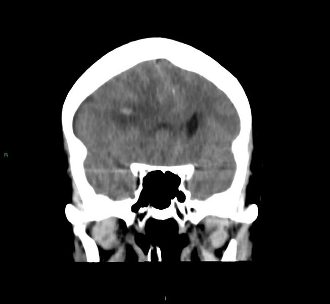 File:Cerebral amyloid angiopathy-associated lobar intracerebral hemorrhage (Radiopaedia 58751-65972 Coronal non-contrast 41).jpg