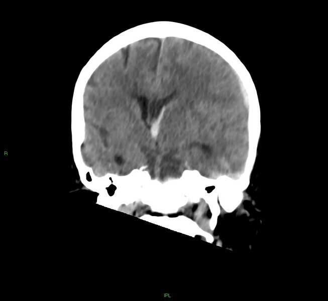 File:Cerebral amyloid angiopathy-associated lobar intracerebral hemorrhage (Radiopaedia 58754-65975 Coronal non-contrast 35).jpg