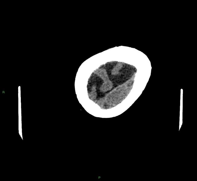 File:Cerebral amyloid angiopathy-associated lobar intracerebral hemorrhage (Radiopaedia 58757-65979 Axial non-contrast 133).jpg