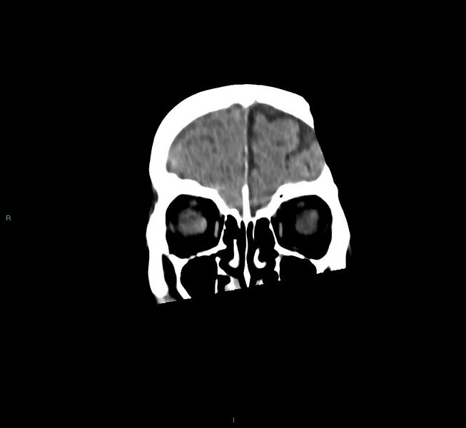 File:Cerebral amyloid angiopathy-associated lobar intracerebral hemorrhage (Radiopaedia 58758-65980 Coronal non-contrast 53).jpg