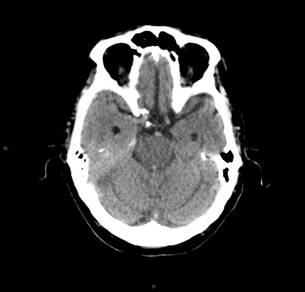 File:Cerebral amyloid angiopathy-associated lobar intracerebral hemorrhage (Radiopaedia 59356-66716 Axial non-contrast 32).jpg