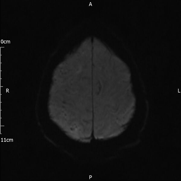 File:Cerebral amyloid angiopathy related inflammation (Radiopaedia 72772-83415 Axial DWI 42).jpg