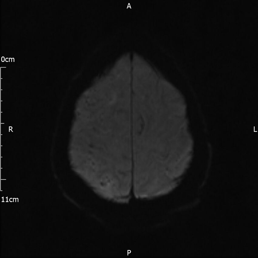 Cerebral amyloid angiopathy related inflammation (Radiopaedia 72772-83415 Axial DWI 42).jpg