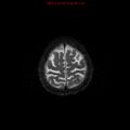 Cerebral and orbital tuberculomas (Radiopaedia 13308-13311 Axial T2 19).jpg