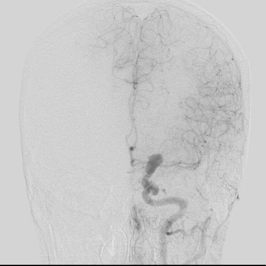 Cerebral aneurysm with rupture (Radiopaedia 29933-30458 LT CCA IC 17).jpg