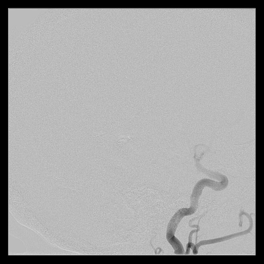 Cerebral aneurysm with rupture (Radiopaedia 29933-30458 LT ICA IC 38).jpg