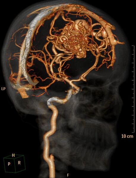 File:Cerebral arteriovenous malformation (Radiopaedia 29531-30031 C 6).jpg