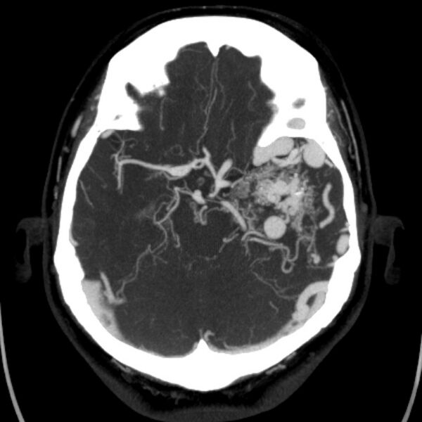 File:Cerebral arteriovenous malformation (Radiopaedia 43729-47189 B 18).jpg
