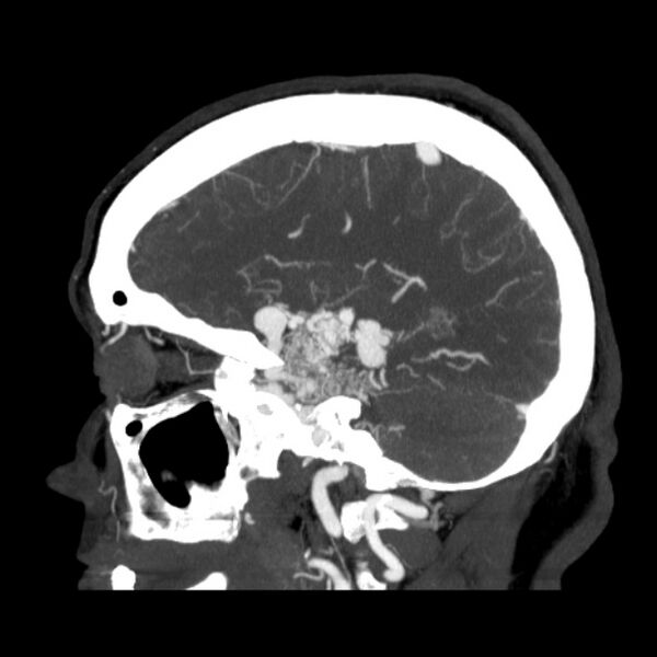 File:Cerebral arteriovenous malformation (Radiopaedia 43729-47189 D 34).jpg