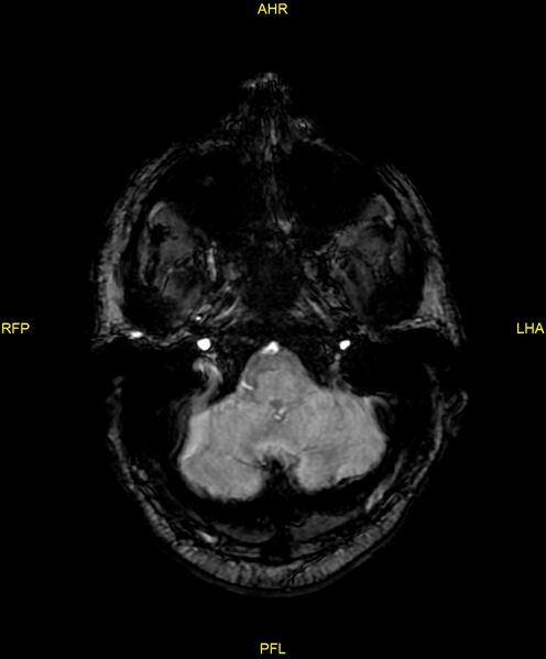 File:Cerebral autosomal dominant arteriopathy with subcortical infarcts and leukoencephalopathy (CADASIL) (Radiopaedia 86108-102054 Axial SWI 19).jpg