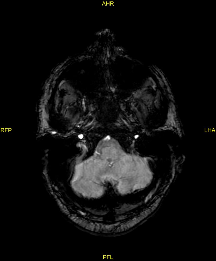 Cerebral autosomal dominant arteriopathy with subcortical infarcts and leukoencephalopathy (CADASIL) (Radiopaedia 86108-102054 Axial SWI 19).jpg